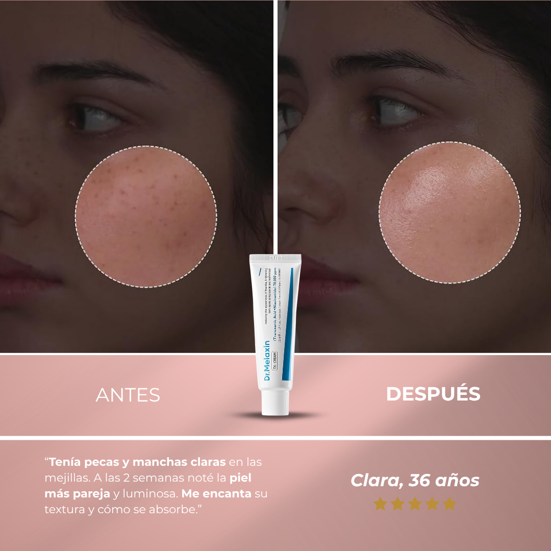 Sanorys Acid™ - Crema facial coreana eliminadora de manchas